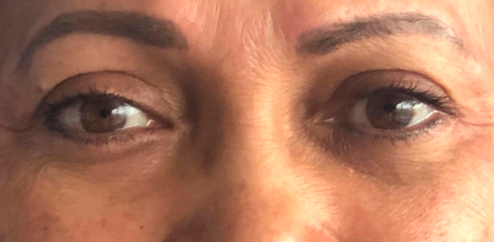 After-Blefaroplastia