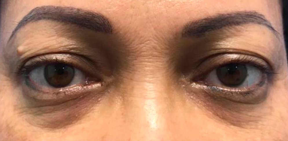 Before-Blefaroplastia