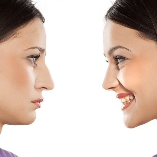 Cirugía Estética de la Nariz  (Rinoplastia)